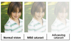 Graphic Showing Differences between normal vision, mild cataract, and advancing cataract